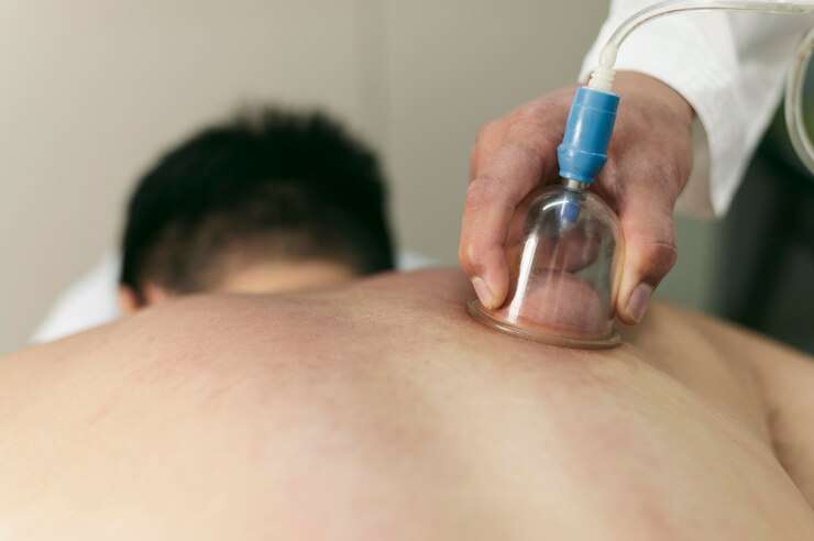 Acupuncture Treatment Dubai